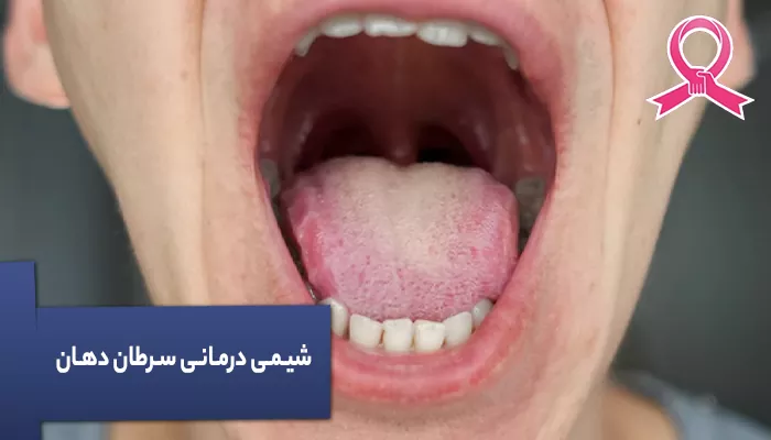 شیمی درمانی سرطان دهان