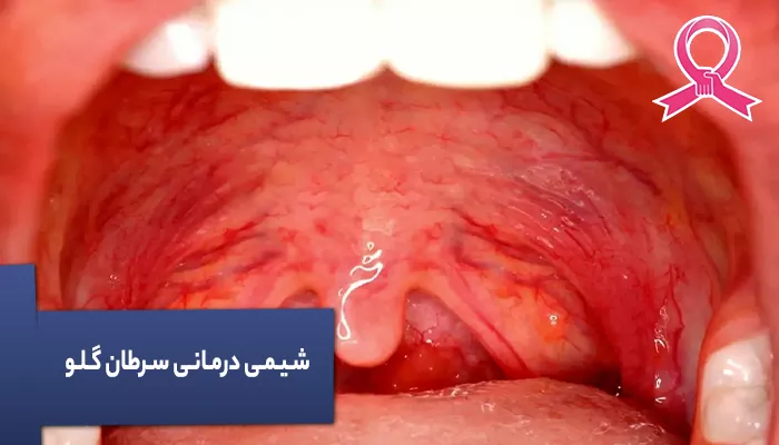 شیمی درمانی سرطان گلو
